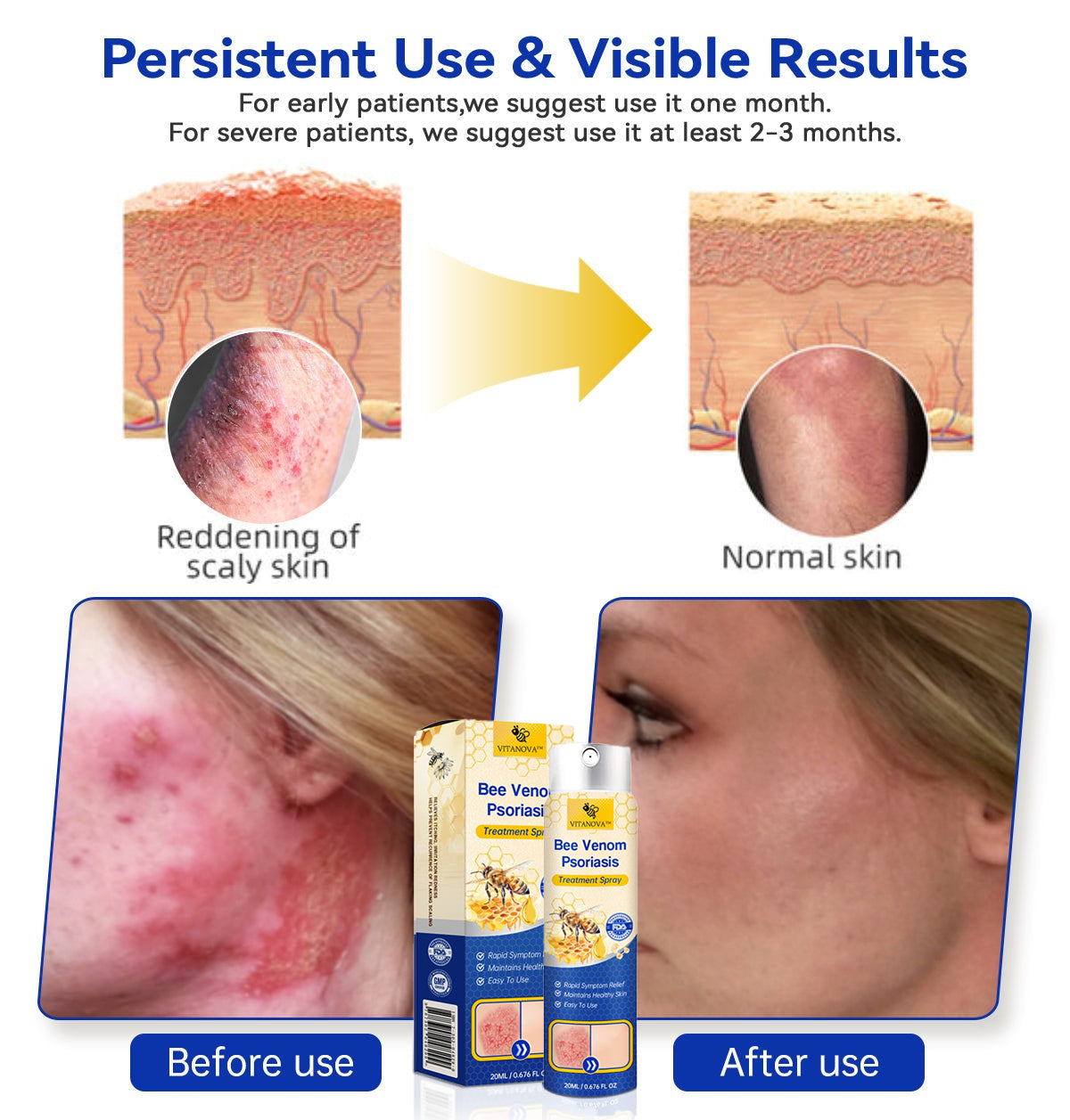 (🔥 78% off last day bundle purchase 🔥) VitaNova™  PsoriaHeal psoriasis Spray pro🐝Global Shipping